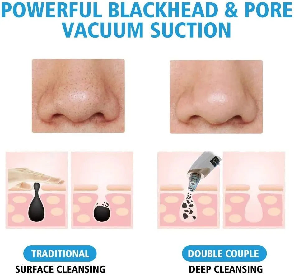 Blackhead Remover Machine 4 in 1